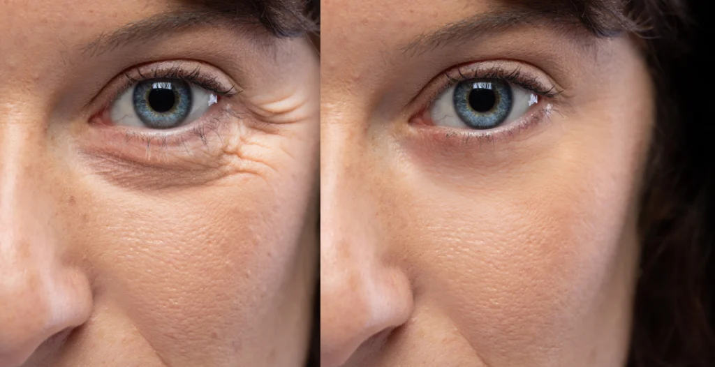 Close-up before-and-after comparison highlighting smoother under-eye wrinkles after a Botox treatment.