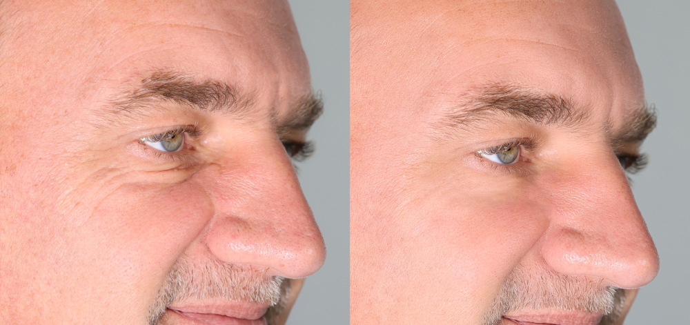 Before and after effects of wrinkle relaxers on a man's face.