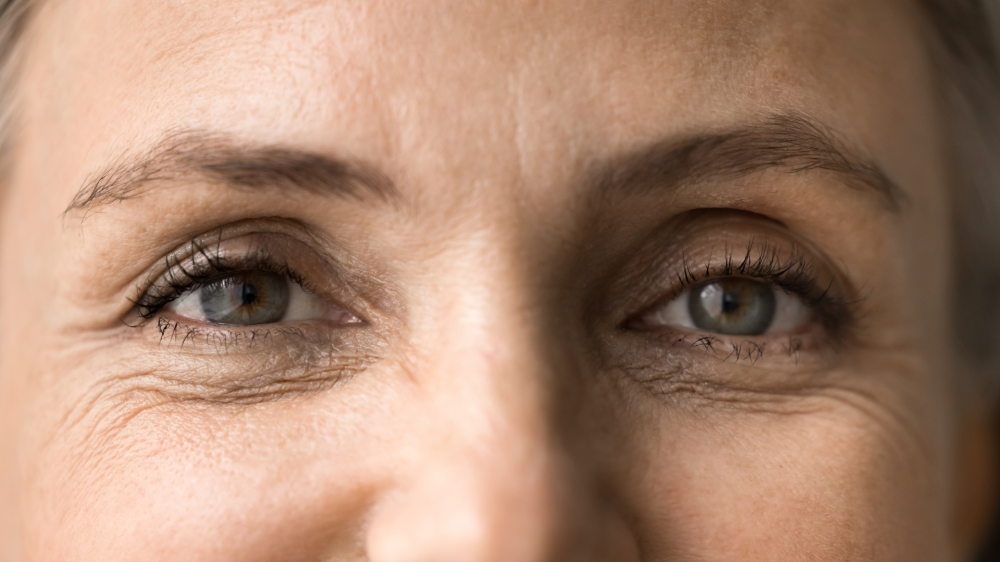 Close-up of eye wrinkles before wrinkle relaxers.