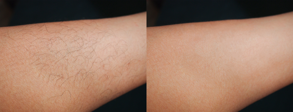 Arm before and after laser hair removal showing smooth, hair-free skin.