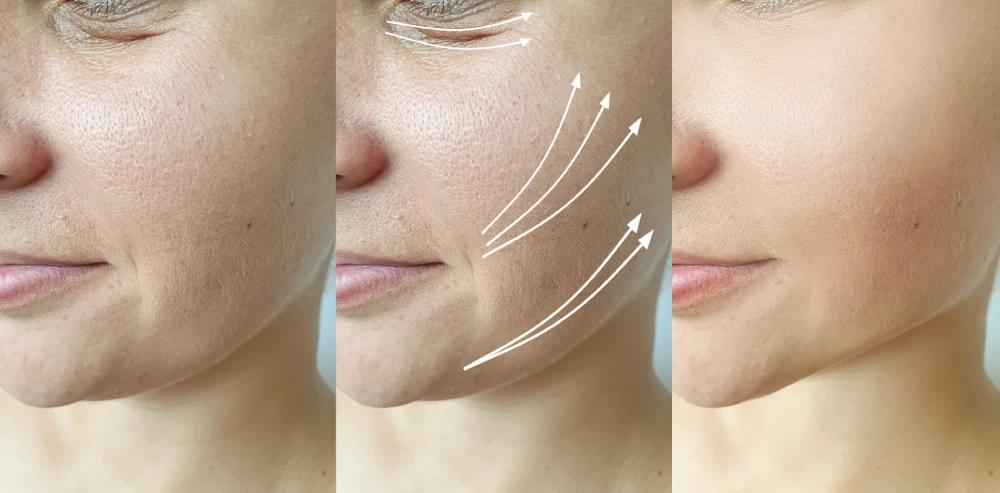 Close-up showing the skin-lifting effects of PDO threads before and after treatment.