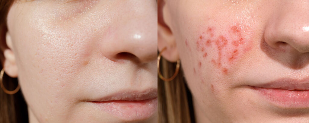 two side-by-side close-ups of a woman’s cheek showing visible acne and clear skin