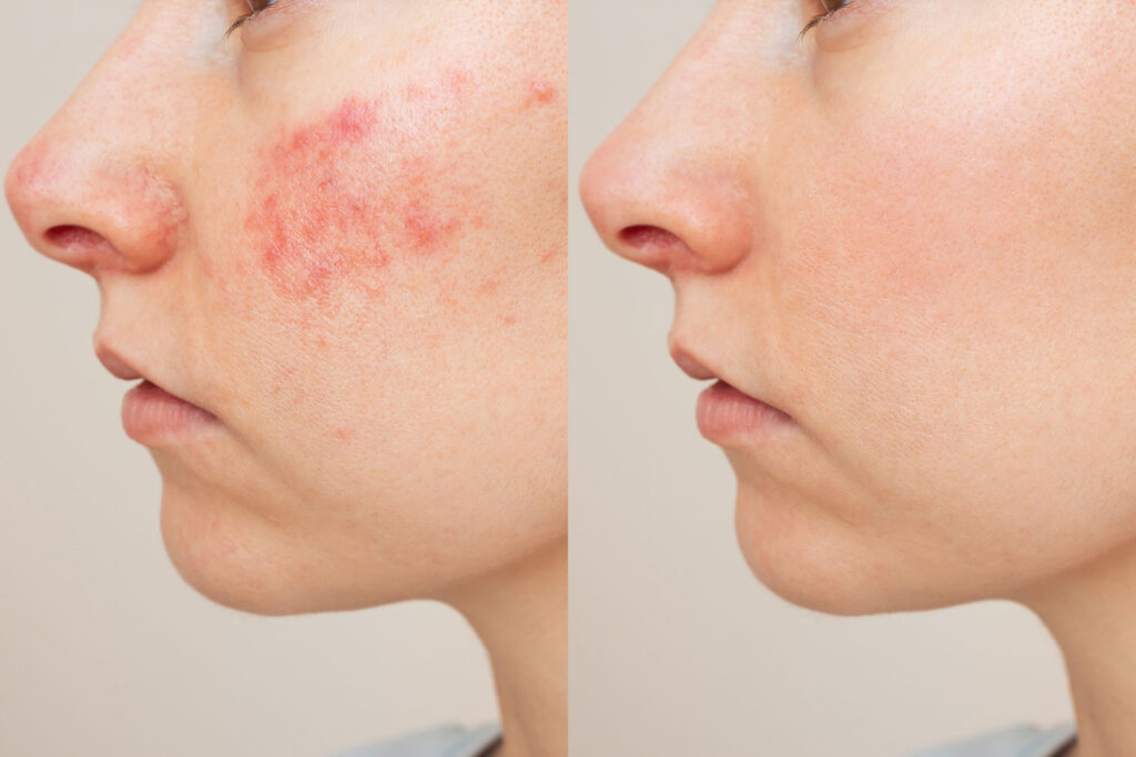 Before and after IPL treatment showing clear improvement in skin redness.