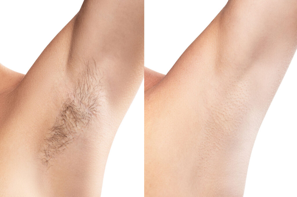 Before and after hair removal showing clean underarms.