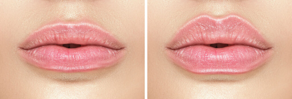 two side-by-side close-ups of lips showing subtle shape differences