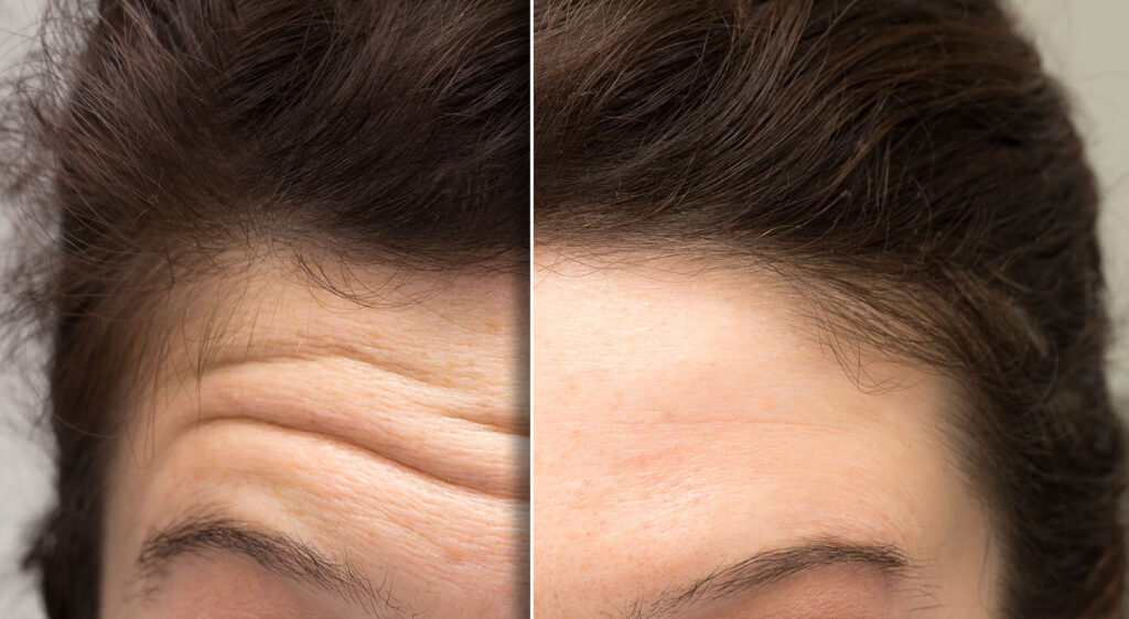Side-by-side forehead close-up showing deeper horizontal lines on the left and fewer visible lines on the right