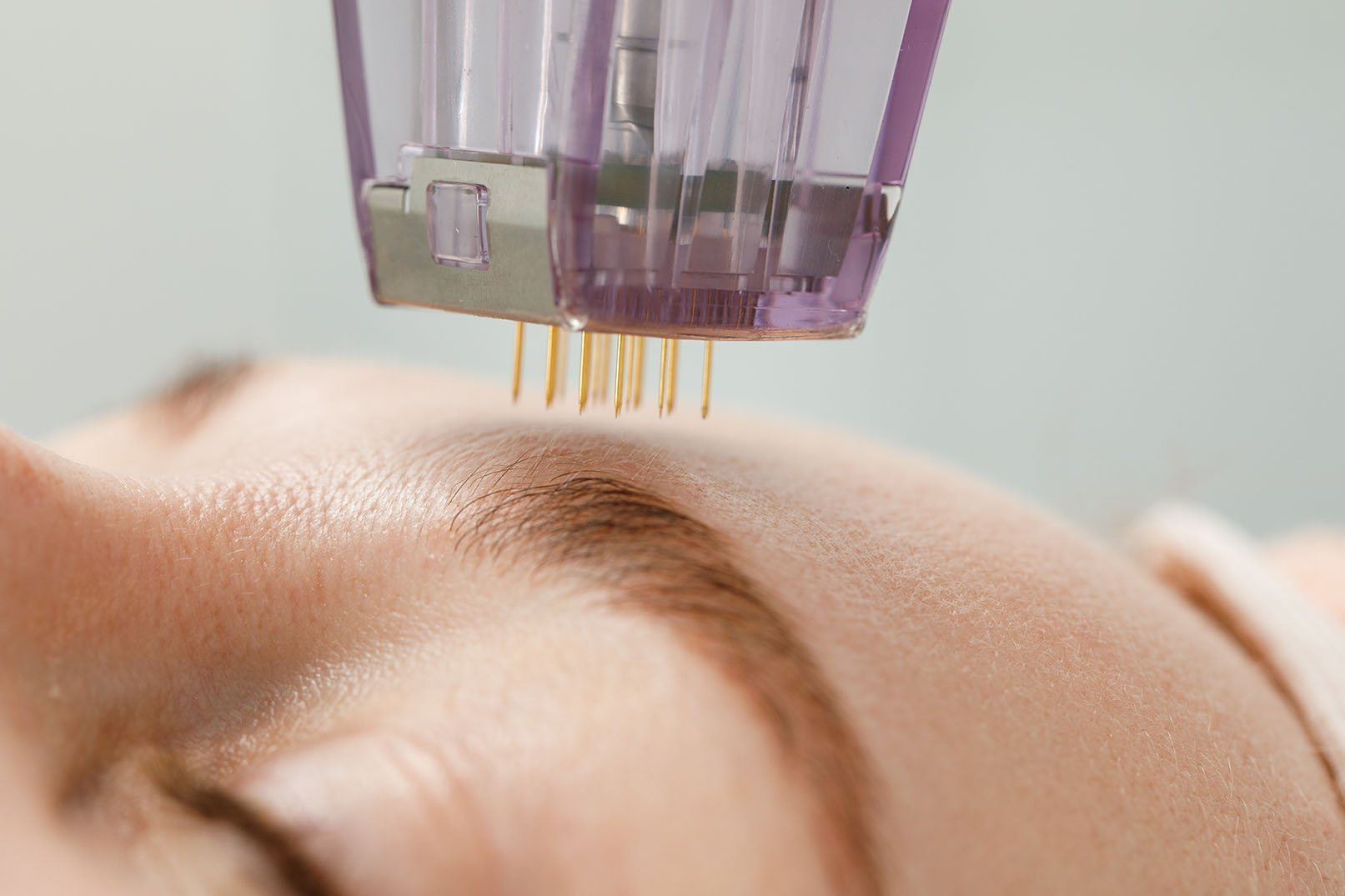 Microneedling cartridge positioned above the forehead of a patient wearing protective eye covers.