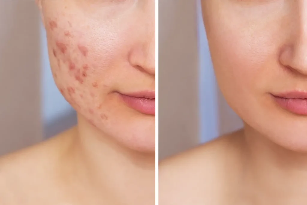 before and after RF microneedling showing reduced acne scars and smoother skin