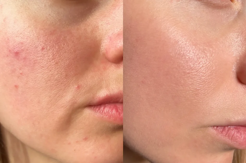 Side-by-side comparison of acne-affected skin and clearer skin